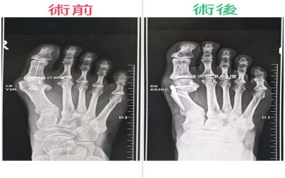 截骨合併矛式骨鋼板固定術治癒腳趾外翻