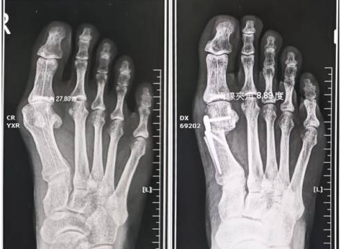 截骨合併矛式骨鋼板固定術治癒腳趾外翻
